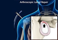 Arthroscopic Labral Repair (Bankart Repair)